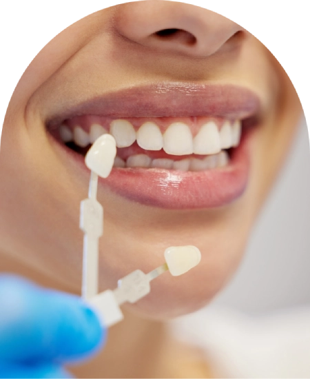 Veneers and Crowns dentist cabarita