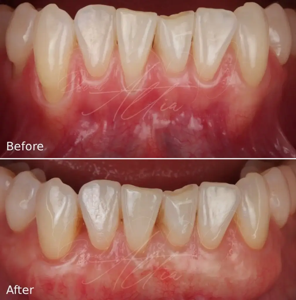 Before After Gum Disease Treatment 1010x1024
