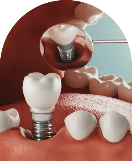 Dental Implants  Dentist Gladesville