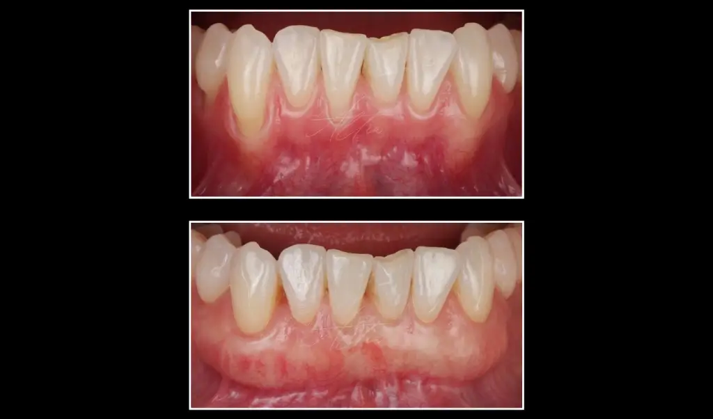 Gum Grafting That Rebuilds with Care