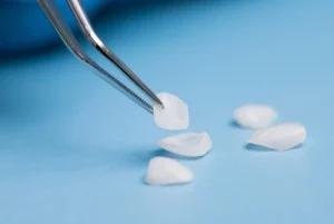 Natural Looking Veneers shells