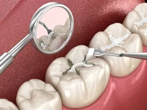 Temporary Tooth Filling placement Temporary Tooth Filling placement