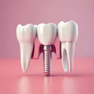 A dental implant being placed between two existing healthy teeth. A dental implant being placed between two existing healthy teeth.