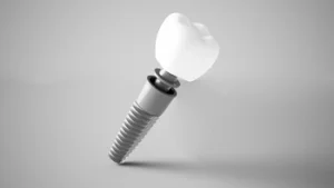 dental implant illustration with parts dental implant illustration with parts