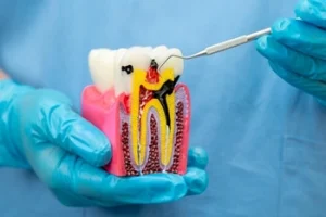 decayed tooth shown in model decayed tooth shown in model